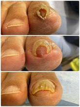 おの整体院 かものみや分院/巻き爪のビフォーアフター