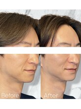 ルミライ(Lumirai)/ 切らずにお顔を小さくする