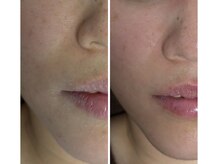 ノレーヴ(NOS REVES)/乾燥肌