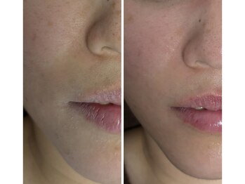 ノレーヴ(NOS REVES)/乾燥肌