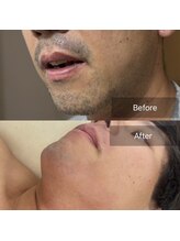 リエラ(Liella)/ヒゲ脱毛　before→after