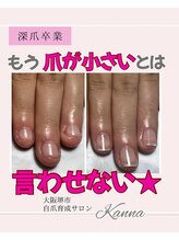 カンナ(Kanna)/「深爪改善｜自爪育成」