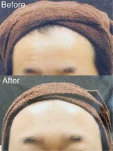 ブランシェ 野々市店 × 椿/シワ・たるみケア　お客様