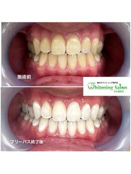 ホワイトニングサロン 名古屋駅店/【ホワイトニング施術例】