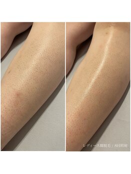 エクラ(eclat)/レディースひざ下脱毛