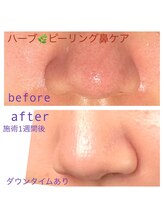 ココ 2号店(CoCo)/鼻周り毛穴/毛穴詰り/毛穴改善