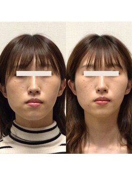 アレイズ/小顔矯正コース(10回)