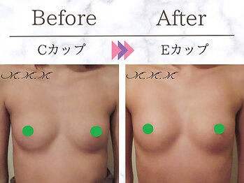 メディカルサロン エム エム エム 大阪梅田グランドサロン(M.M.M)/【バストアップ例】　C→Eカップ