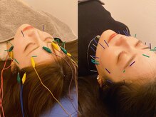 恵比寿駅前整骨院はり院 別館/小顔　美容鍼　リフトアップ　