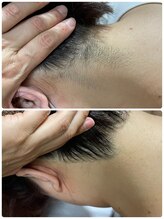 エクシア(excia)/レディースうなじ脱毛