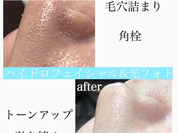 グレイティア(gratia)/毛穴洗浄&光フォト