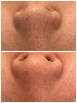 メゾンリュバン 天王寺(Maison Ruban)/毛穴洗浄|毛穴ケア