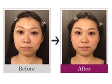 ビコツゼロ 青山(BIKOTSU ZERO)/小顔・目の高さ・むくみ