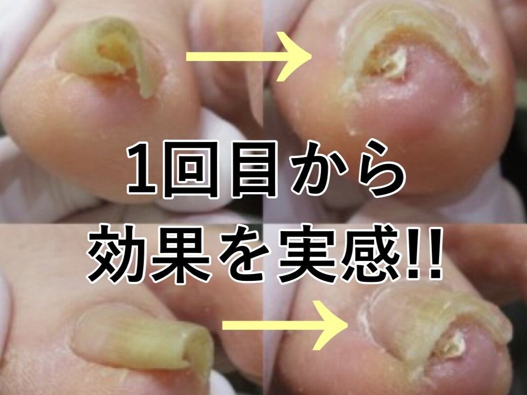 巻き爪 ペディグラス クチコミに関するネイル・まつげサロン 巻き爪 ペディグラス クチコミに関するネイル・まつげサロン