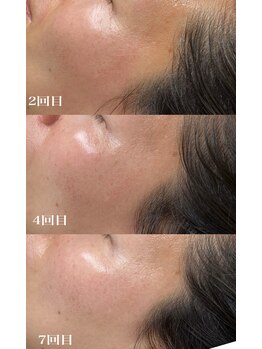 フーフラット(Huu flat)/フェイシャルワックス