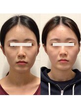 アレイズ/小顔矯正コース（10回）