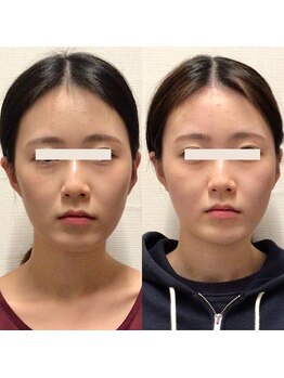 アレイズ/小顔矯正コース(10回)