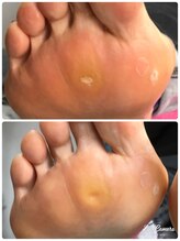 カリーラ/タコ・魚の目ケア