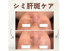 サロン ド Rの雰囲気（剥離無しのハーブピーリングで毛穴もくすみもキレイになります）