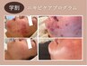 【学割U24】ニキビでお悩みの方はこちら！ニキビケアプログラム　初回体験