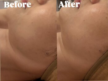 メルシー サロン(Merci Salon)/5分で!首たるみ小顔アプローチ