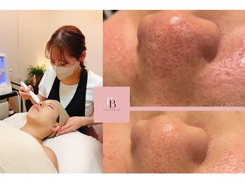 フォトビズの写真/肌育サロン【毛穴レス＆艶肌肌育】フォト＋ハイドラ毛穴洗浄+ヒト幹細胞+高濃度パック8800円が人気