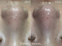 ナチュールムーン(Nature moon.)/毛穴洗浄