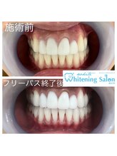 ホワイトニングサロン 四日市white/差し歯・インプラントも◎