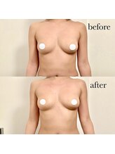 ボニー(BONNY)/バスト　ビフォアフター☆