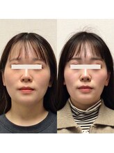 アレイズ/小顔矯正コース（10回）