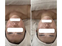 リトリート(Retreat)/1度のフェイシャルの変化