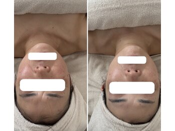 リトリート(Retreat)/1度のフェイシャルの変化