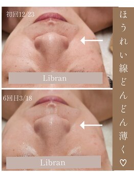 リブラン(Libran)/40代のお客様★ほうれい線変化