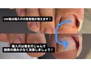 GW後は陥入爪の方が急増します