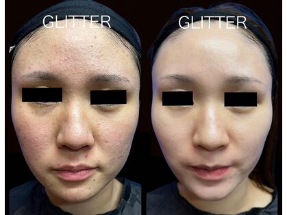 グリッター(GLITTER)の写真