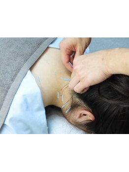 鍼灸施術を受けたい