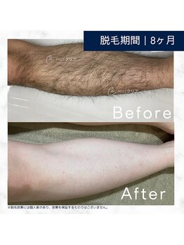 メンズクリア アスピア明石店/【メンズクリア】お客様の施術例