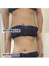 グラン ジュテ/集中痩せ【レモンボトル】