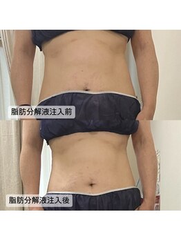 グラン ジュテ/集中痩せ【レモンボトル】