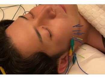 デルタエヌピー63+(δnp63+)/小顔鍼[小顔/薬院/フェイシャル]