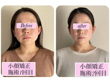 よしみち整体院/小顔矯正施術２回目の結果♪