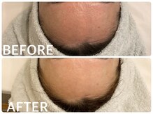 ハーブピーリング 恵比寿/くすみ/ざらつき/毛穴