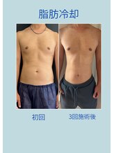 ウルト アルティメイトスキン(ULT ultimate skin)/リバウンドしづらいダイエット！