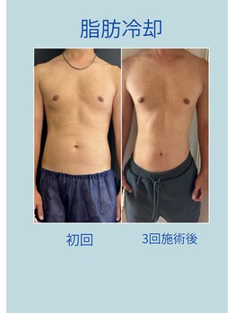 ウルト アルティメイトスキン(ULT ultimate skin)/リバウンドしづらいダイエット!