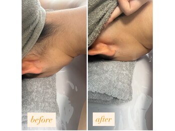 エム(M)/うなじビフォーアフター