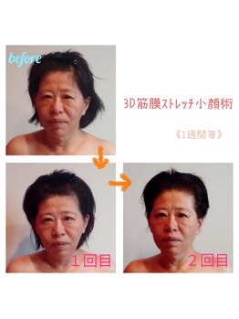 ビューティサロン キヨの部屋(beauty salon)/【３D筋膜ストレッチ小顔術】2回