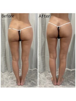 ブーケ/フェムケア　Before & After