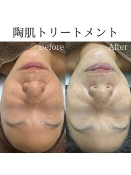 ビューティービューティー(BEAUTY BEAUTY)/陶肌トリートメント