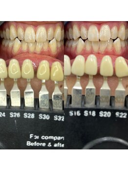 トウキョウスワーズ 池袋店(TOKYO SWRS)/#ホワイトニング #池袋 #渋谷