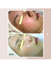 レゾン 京橋店/【ビフォーアフター】ニキビケア